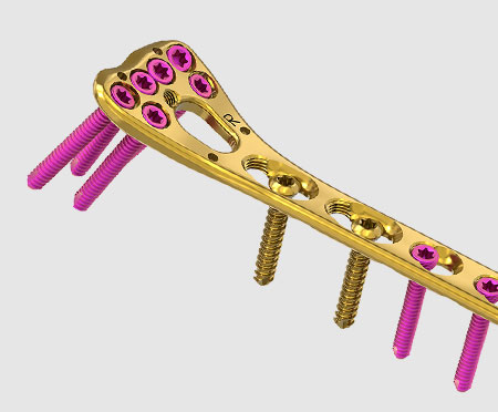 Orthopedic Implants